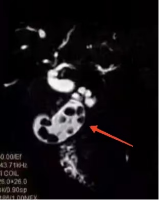 【中西医科普】腹痛CT查不出结石？MRCP能揪出胆囊里的“隐形小石头”916.png